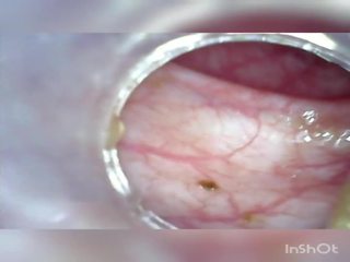 深 深 肛交 再次 家 colonoscopy endoscope 第一 部分